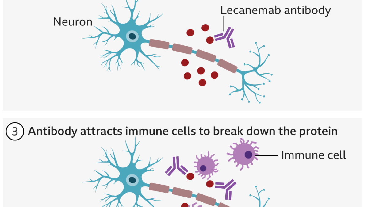 Canada's Drug Agency Backs Public Funding for Early Alzheimer's Treatment